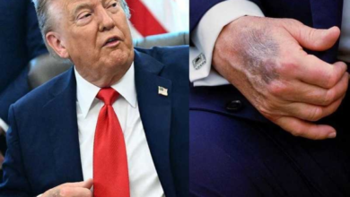 ترامب يكشف سر كدمات يده ويتباهى بصحته العقلية