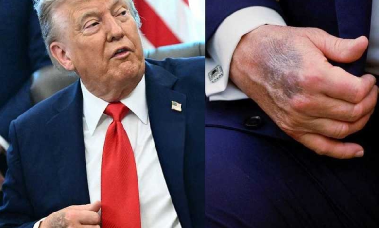 ترامب يكشف سر كدمات يده ويتباهى بصحته العقلية