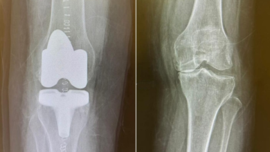 مستشفى الدرعية: نجاح برنامج تأهيلي لمريض بعد زراعة المفصل