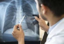 دراسة: العفن المنزلي يدمر رئات الأطفال لسنوات طويلة