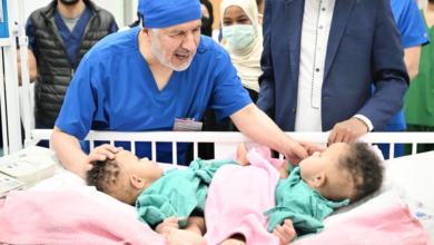 نجاح فصل التوأم الصومالي رملا ورحمة في السعودية