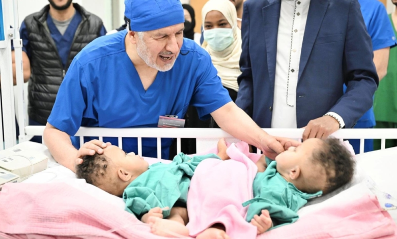 نجاح فصل التوأم الصومالي رملا ورحمة في السعودية