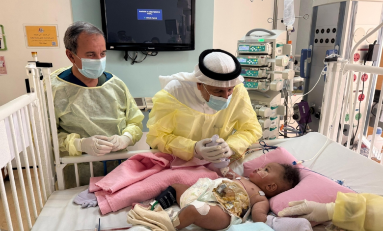 استقرار حالة التوأم الصومالي رحمة ورملا بعد عملية الفصل