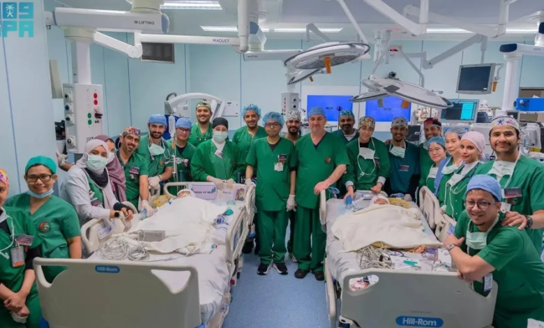 نجاح فصل توأم سيامي فلبيني بالسعودية في عملية معقدة