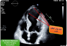 جراحة قلب نادرة تنقذ سبعينياً في مدينة الملك سعود الطبية