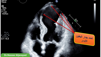 جراحة قلب نادرة تنقذ سبعينياً في مدينة الملك سعود الطبية