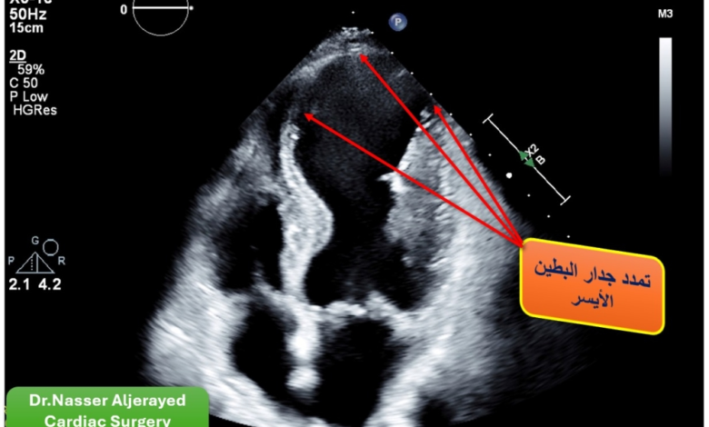 جراحة قلب نادرة تنقذ سبعينياً في مدينة الملك سعود الطبية