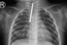 إنقاذ حياة رضيع بالرياض: استخراج مسمار من مجرى التنفس