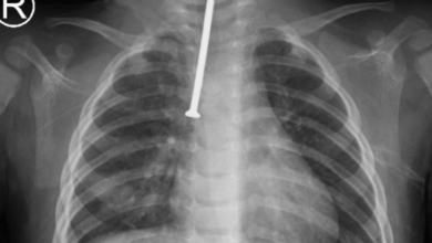 إنقاذ حياة رضيع بالرياض: استخراج مسمار من مجرى التنفس