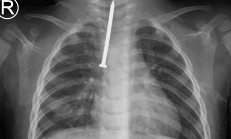 إنقاذ حياة رضيع بالرياض: استخراج مسمار من مجرى التنفس