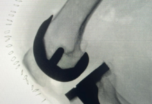 استبدال مفصل الركبة والمشي بنفس اليوم بمدينة الملك سعود