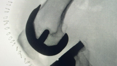 استبدال مفصل الركبة والمشي بنفس اليوم بمدينة الملك سعود