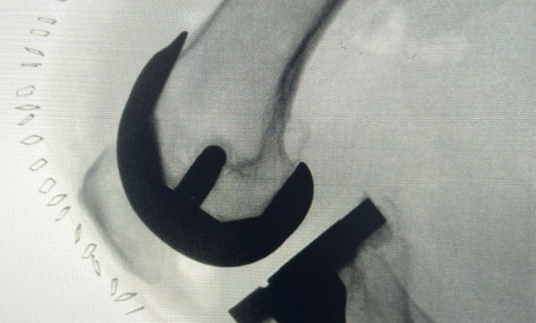 استبدال مفصل الركبة والمشي بنفس اليوم بمدينة الملك سعود