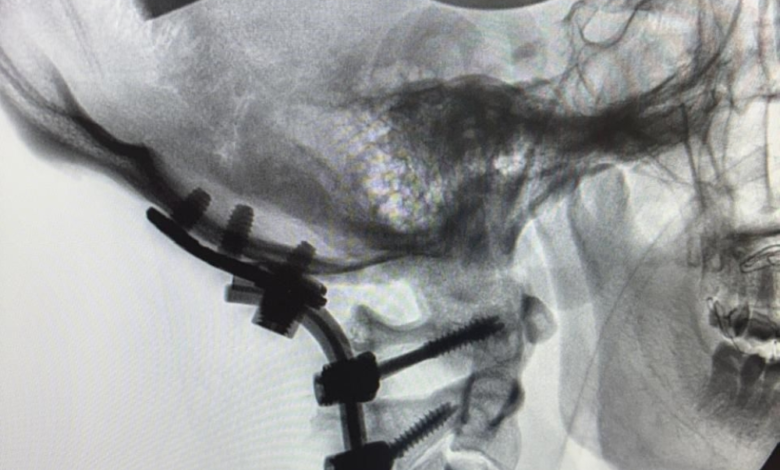 سعود الطبية تنجح بجراحة نادرة لإنقاذ مريض من خلع الرقبة