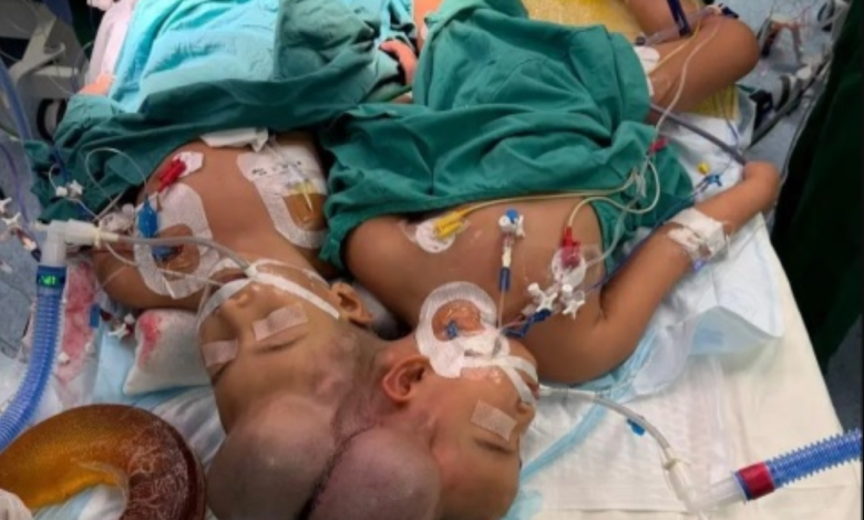 فصل التوأم الفلبيني بالرياض: إنجاز طبي سعودي جديد