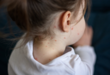 تفشي الحصبة في بنغلاديش: وفاة 194 طفلاً وأزمة صحية عالمية