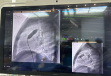 نجاح أول قسطرة قلب للأطفال في القريات: إنجاز طبي كبير