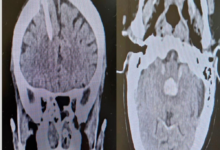 A woman in her fifties was saved from a brain hemorrhage at Prince Abdulmohsen Hospital
