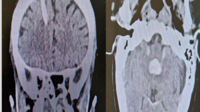 A woman in her fifties was saved from a brain hemorrhage at Prince Abdulmohsen Hospital